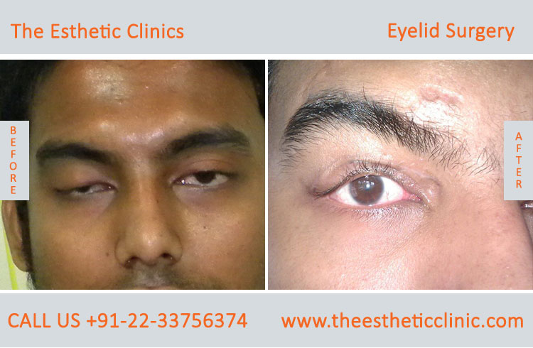 Eyelid Surgery, Blepharoplasty before after photos in mumbai india (7)